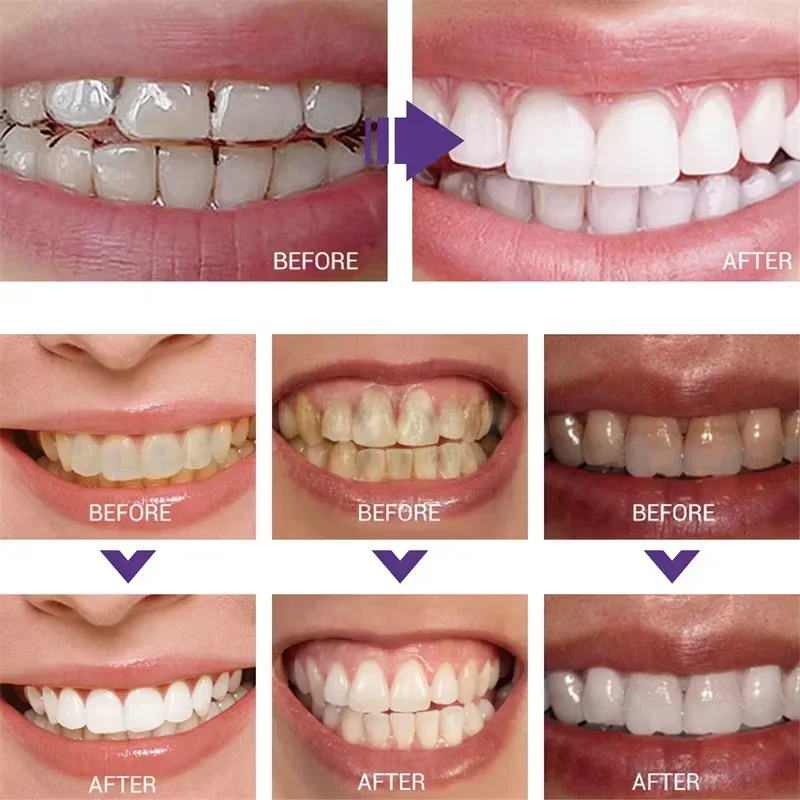 ยาสีฟันทำความสะอาดฟัน ฟอกสีฟัน - Teeth Whitening In Korea บทวิจารณ์และราคา