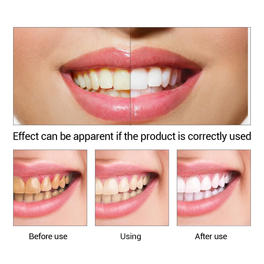 FTEENPLY ฟันไวท์เทนนิ่ง Oral ส - Teeth Whitening Q&M บทวิจารณ์และราคา