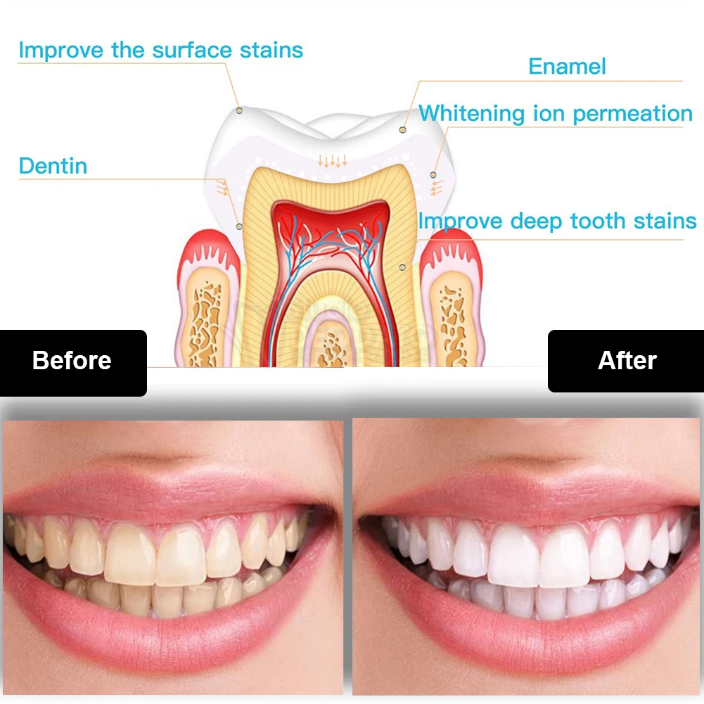 ทันตกรรมชุดฟอกสีฟัน Mini 16 LE - Teeth Whitening Q&M บทวิจารณ์และราคา
